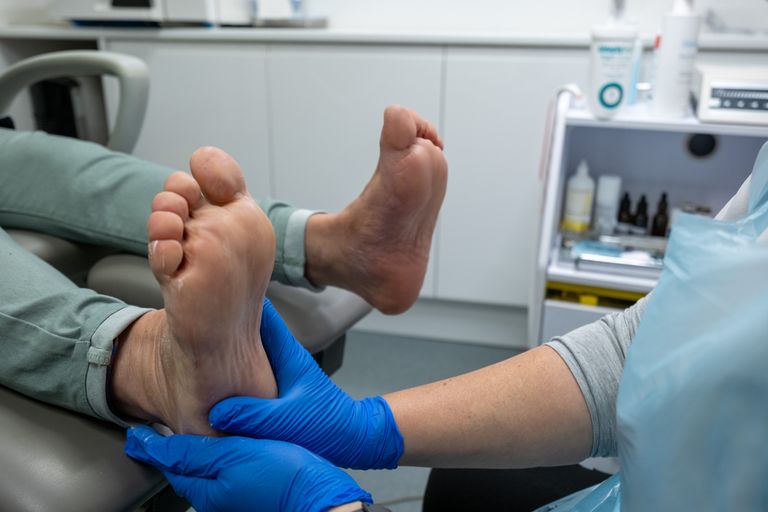 Podiatrist treating verrucas 