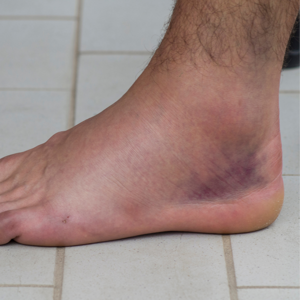 I've Sprained My Ankle- What Should I Do?