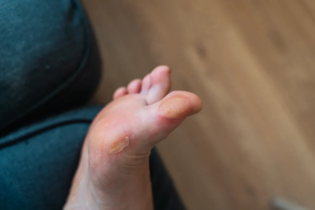 close up of a soft callus on a foot of a woman sp 2026 03 16 22 57 45 utc