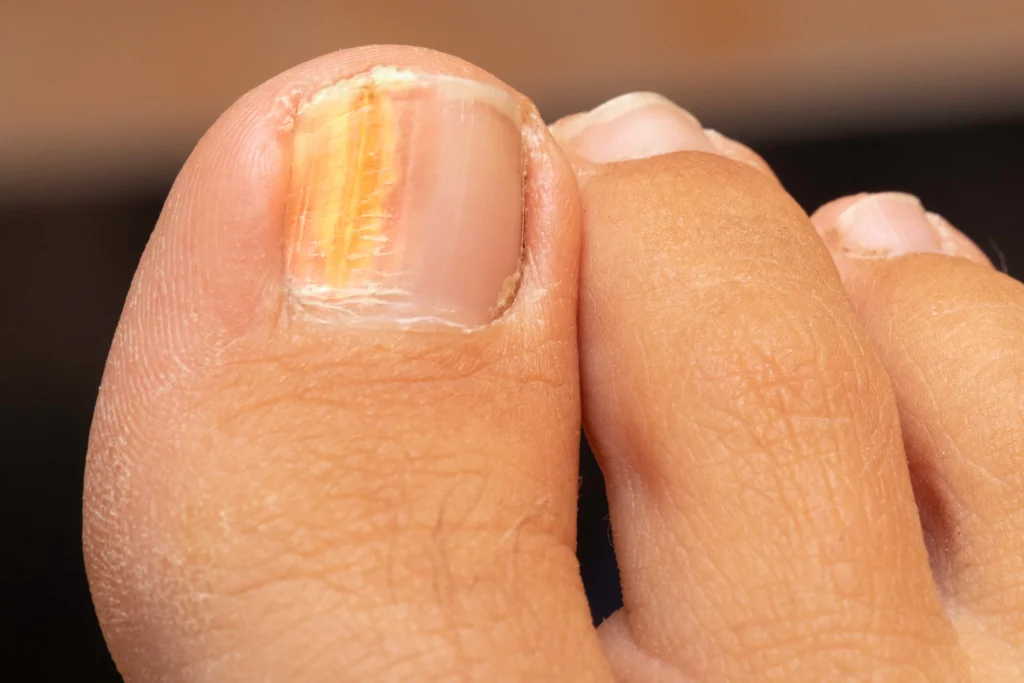 closeup view foot person with yellow thick big toenail symptoms onychomycosis
