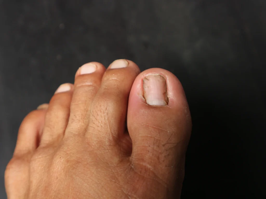 estering fungus damaged big toenail isolated black background
