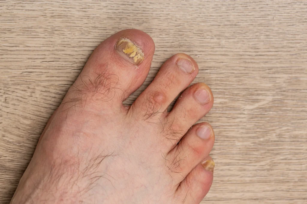 feet man close up fingers affected by fungal nail plate ugly toes