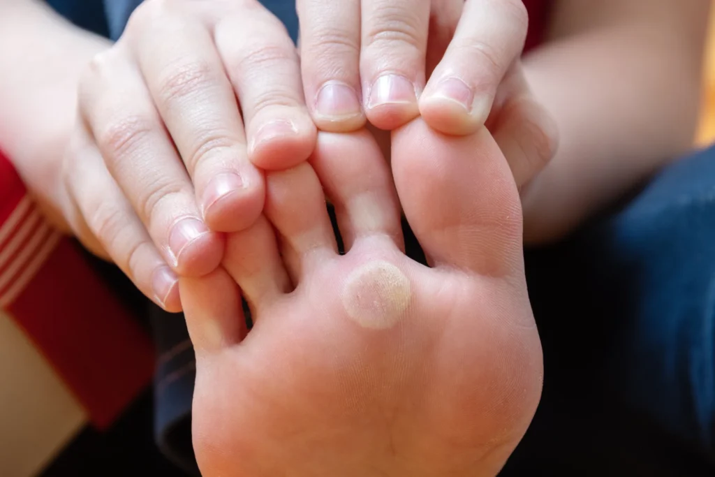 foot with problem areas skin dry corn plantar wart foot unhealthy foot skin concept cosmetology skin care concept
