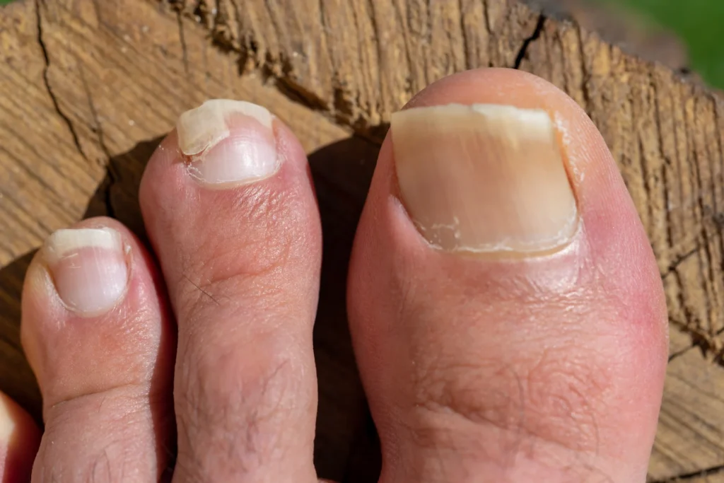 fungal toenail infection