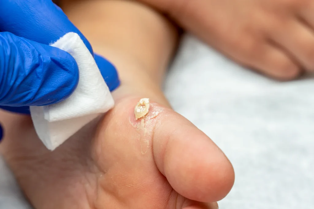 healing treatment cracked dry wart calluses child foot sole