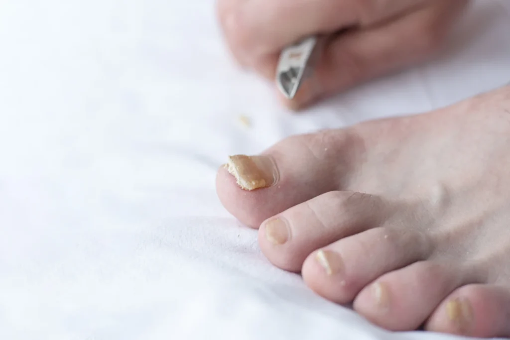 male cut nails with nail fungus fungal infection hands legs finger with onychomycosis care treatment closeup foot with damaged nails because fungus