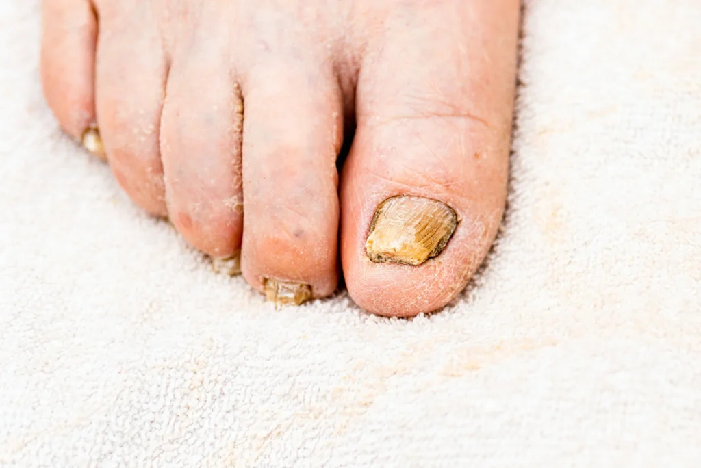 nail fungus legs nail diseasefungus infection nails mans footcloseup shot