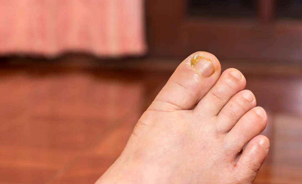 nail sores toes healthy healthcare concept