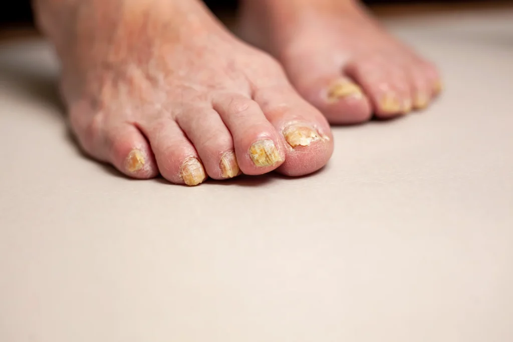 onycholysis nails paramedicine pedicure aging problems toenails affected by fungal infection