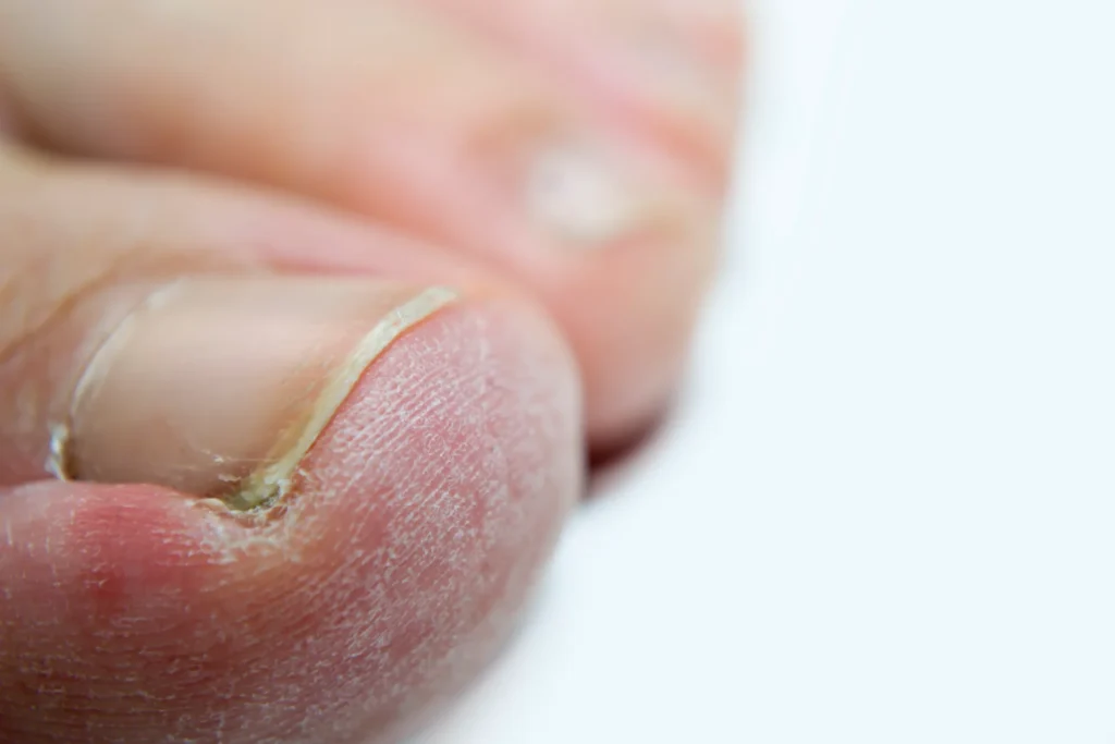 peeling skin fingers white background your article about foot care