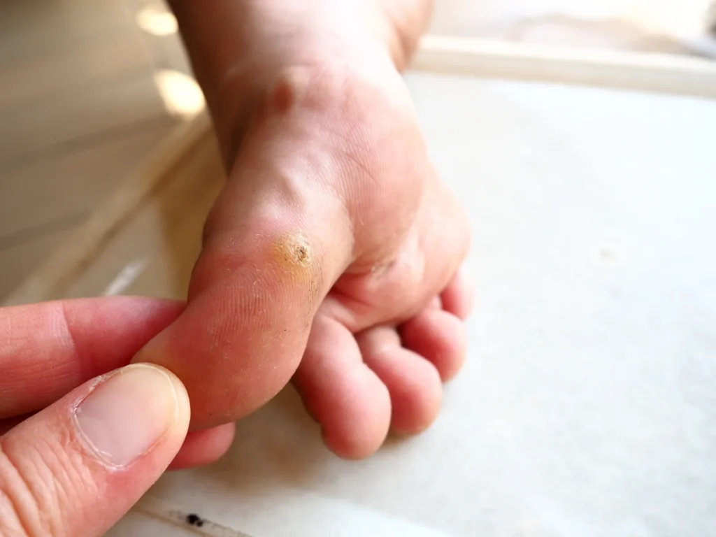 plantar warts verruca plantaris are warts caused by human papillomaviruses hpv appear soles toes defeat sole foot hard rough papules destroying papillary patterns 1