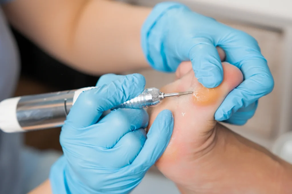 podologist carries out callus removal from a woman 2026 03 19 22 53 58 utc